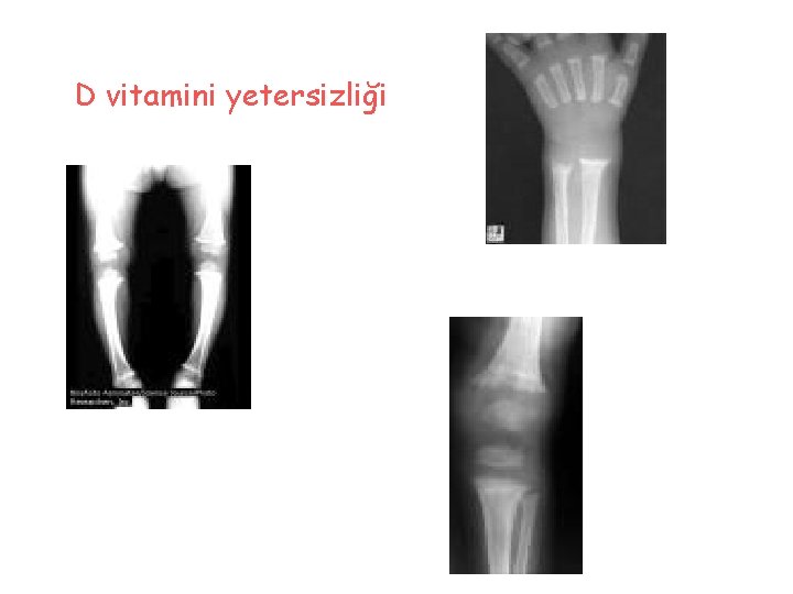D vitamini yetersizliği 
