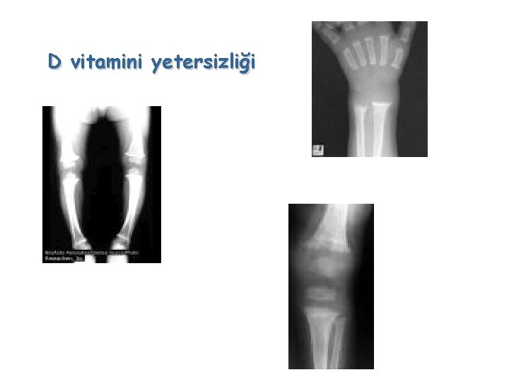 D vitamini yetersizliği 