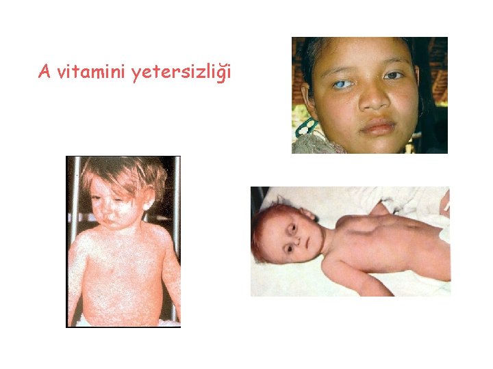A vitamini yetersizliği 