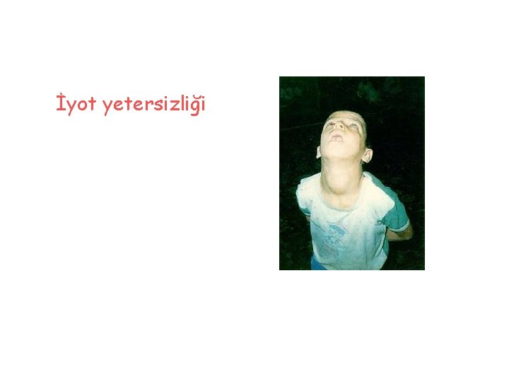 İyot yetersizliği 