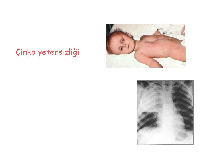 Çinko yetersizliği 