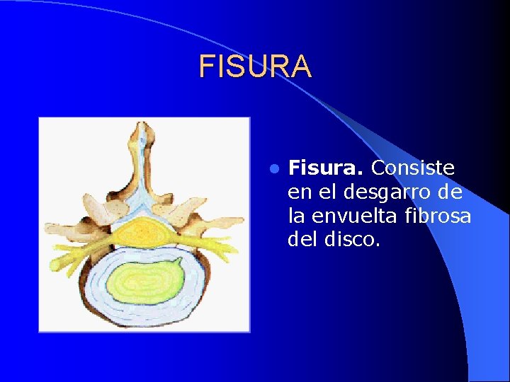 FISURA l Fisura. Consiste en el desgarro de la envuelta fibrosa del disco. 