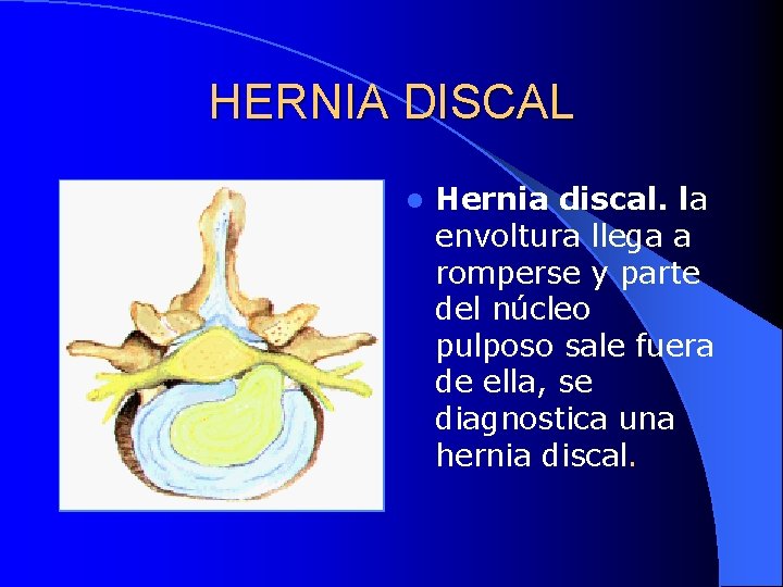 HERNIA DISCAL l Hernia discal. la envoltura llega a romperse y parte del núcleo