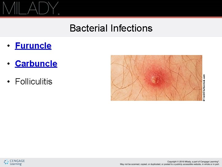Bacterial Infections • Furuncle • Folliculitis © Inxti/Shutterstock. com • Carbuncle 