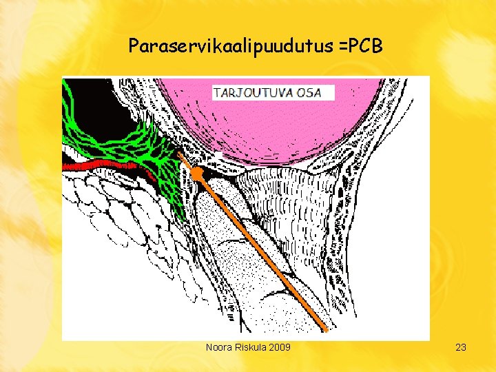 Paraservikaalipuudutus =PCB Noora Riskula 2009 23 