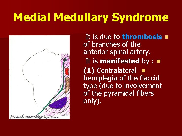 Medial Medullary Syndrome It is due to thrombosis n of branches of the anterior