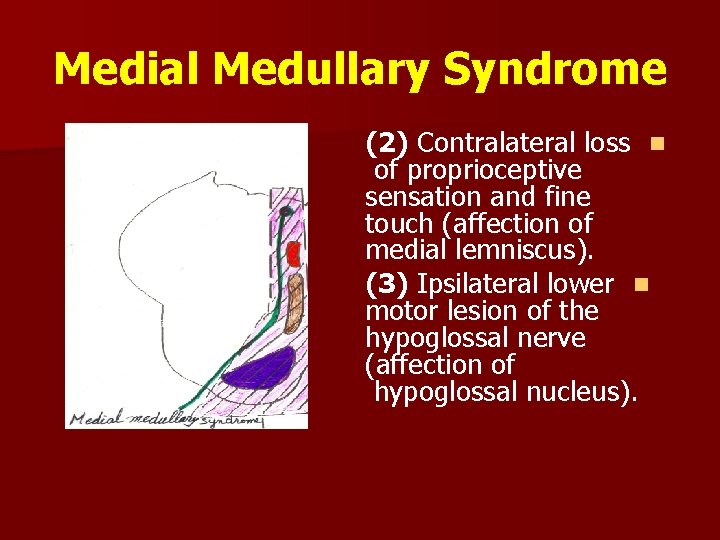 Medial Medullary Syndrome (2) Contralateral loss n of proprioceptive sensation and fine touch (affection