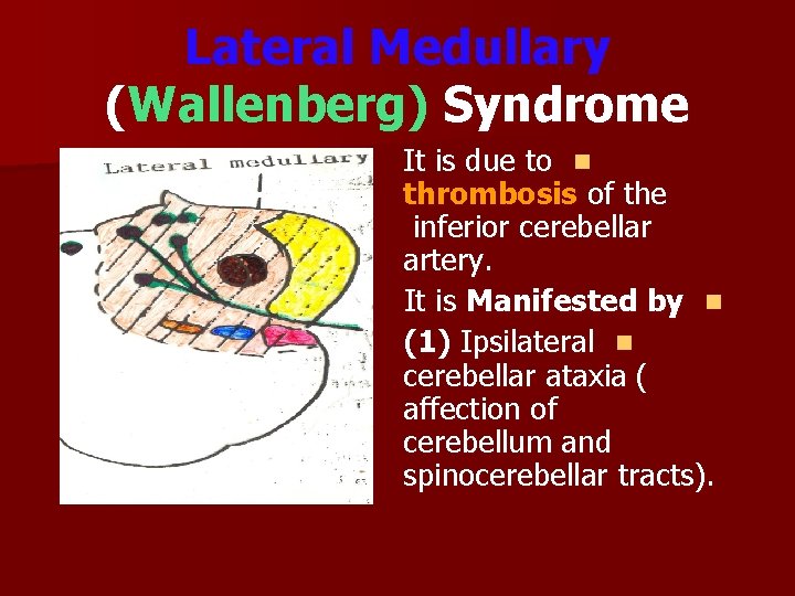 Lateral Medullary (Wallenberg) Syndrome It is due to n thrombosis of the inferior cerebellar
