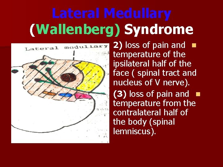 Lateral Medullary (Wallenberg) Syndrome 2) loss of pain and n temperature of the ipsilateral
