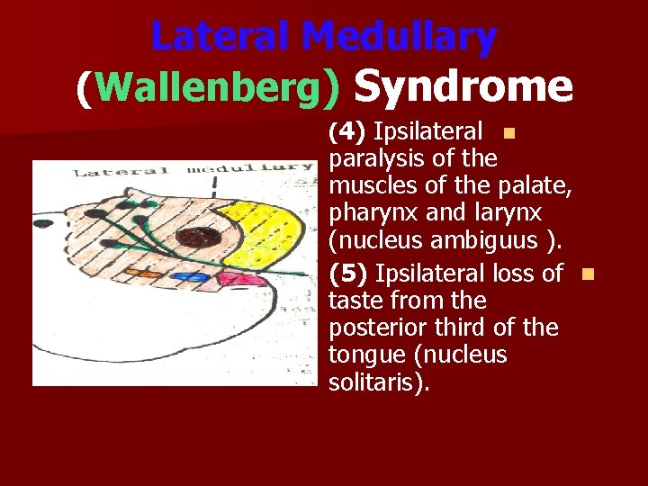 Lateral Medullary (Wallenberg) Syndrome (4) Ipsilateral n paralysis of the muscles of the palate,