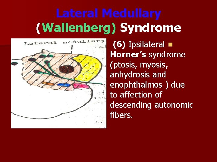 Lateral Medullary (Wallenberg) Syndrome (6) Ipsilateral n Horner’s syndrome (ptosis, myosis, anhydrosis and enophthalmos