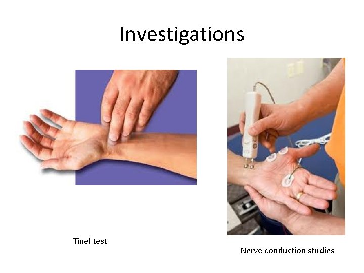 Investigations Tinel test Nerve conduction studies 