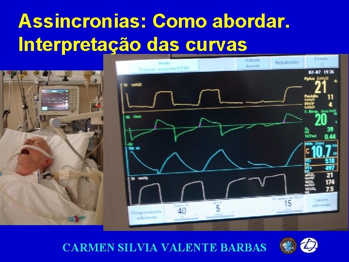 Assincronias: Como abordar. Interpretação das curvas CARMEN SILVIA VALENTE BARBAS 