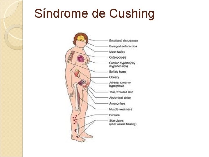 Síndrome de Cushing 