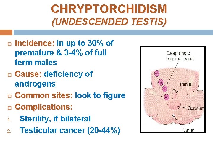 CHRYPTORCHIDISM (UNDESCENDED TESTIS) 1. 2. Incidence: in up to 30% of premature & 3