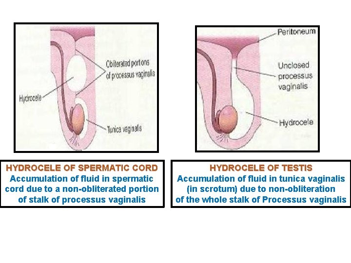 HYDROCELE OF SPERMATIC CORD Accumulation of fluid in spermatic cord due to a non-obliterated