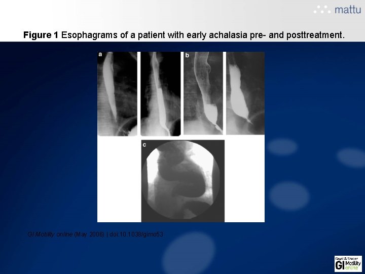 Figure 1 Esophagrams of a patient with early achalasia pre- and posttreatment. GI Motility Figure 1 Esophagrams of a patient with early achalasia pre- and posttreatment. GI Motility
