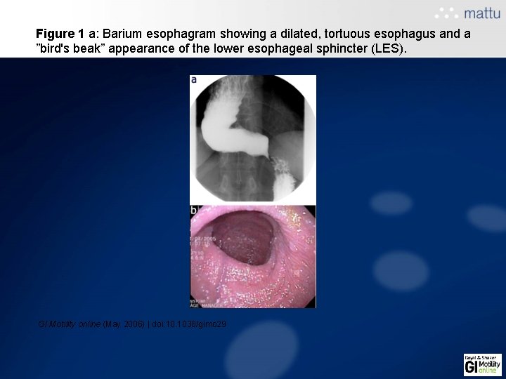 Figure 1 a: Barium esophagram showing a dilated, tortuous esophagus and a ”bird's beak” Figure 1 a: Barium esophagram showing a dilated, tortuous esophagus and a ”bird's beak”