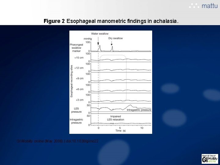Figure 2 Esophageal manometric findings in achalasia. GI Motility online (May 2006) | doi: Figure 2 Esophageal manometric findings in achalasia. GI Motility online (May 2006) | doi: