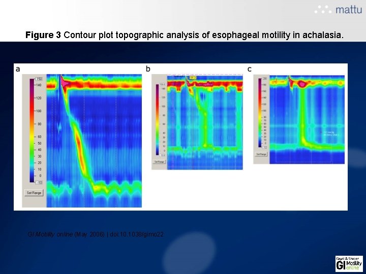 Figure 3 Contour plot topographic analysis of esophageal motility in achalasia. GI Motility online Figure 3 Contour plot topographic analysis of esophageal motility in achalasia. GI Motility online