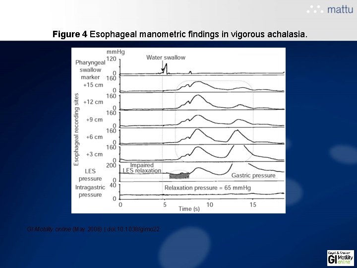 Figure 4 Esophageal manometric findings in vigorous achalasia. GI Motility online (May 2006) | Figure 4 Esophageal manometric findings in vigorous achalasia. GI Motility online (May 2006) |
