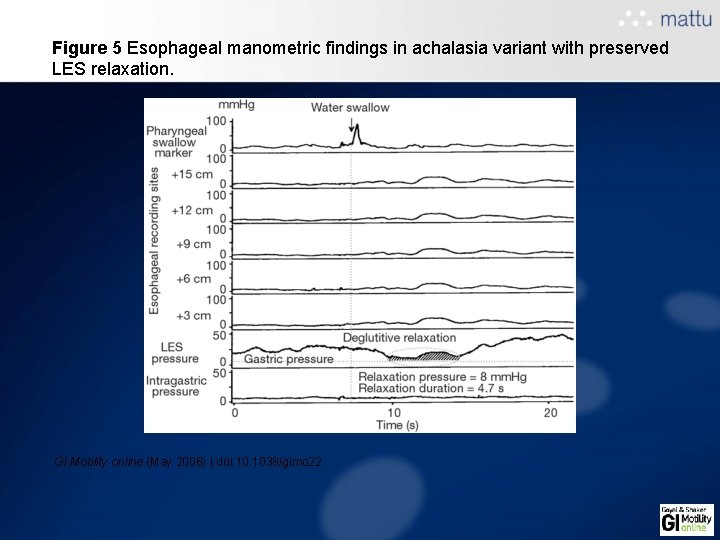 Figure 5 Esophageal manometric findings in achalasia variant with preserved LES relaxation. GI Motility Figure 5 Esophageal manometric findings in achalasia variant with preserved LES relaxation. GI Motility