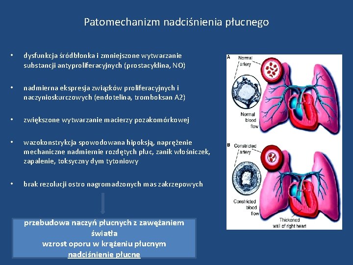 Patomechanizm nadciśnienia płucnego • dysfunkcja śródbłonka i zmniejszone wytwarzanie substancji antyproliferacyjnych (prostacyklina, NO) •