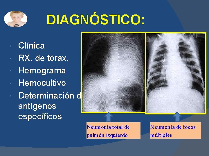 DIAGNÓSTICO: Clínica RX. de tórax. Hemograma Hemocultivo Determinación de antígenos específicos Neumonía total de DIAGNÓSTICO: Clínica RX. de tórax. Hemograma Hemocultivo Determinación de antígenos específicos Neumonía total de