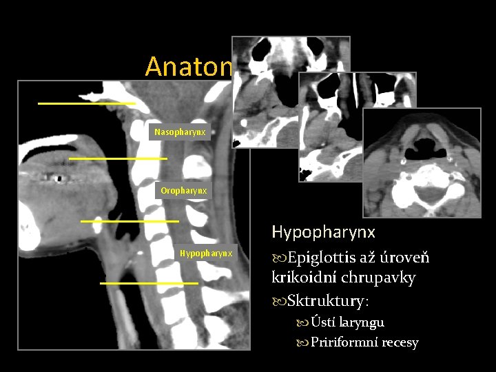 Anatomie hltanu Nasopharynx Oropharynx Hypopharynx Nasopharynx Oropharynx Epiglottis až úroveň Baze lební Měkké patro