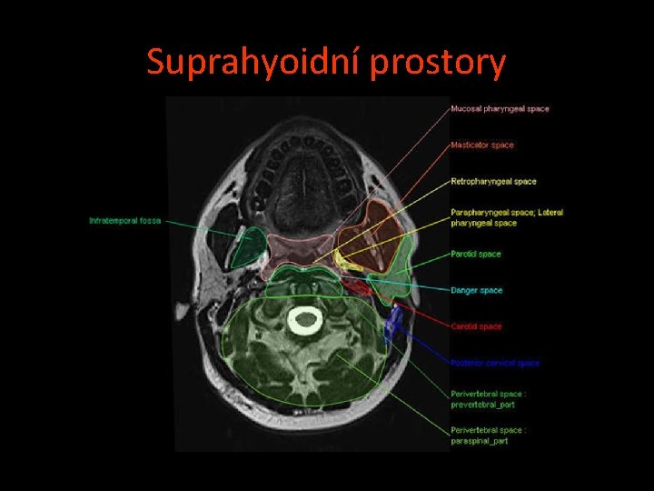 Suprahyoidní prostory 