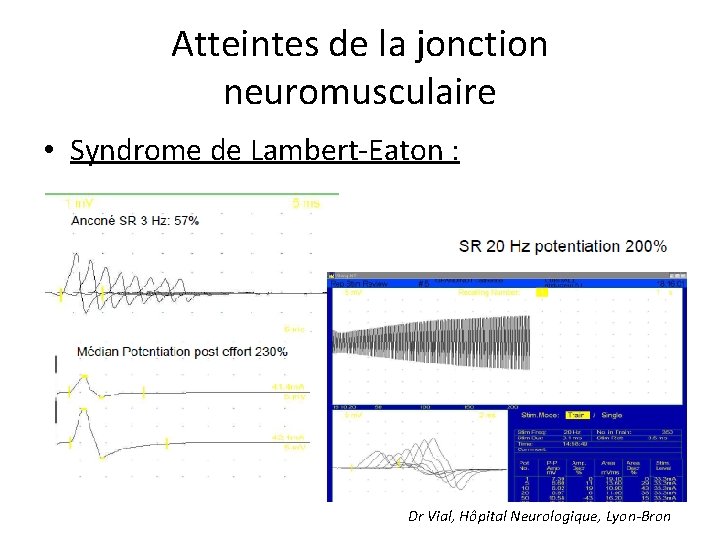 Atteintes de la jonction neuromusculaire • Syndrome de Lambert-Eaton : Dr Vial, Hôpital Neurologique,