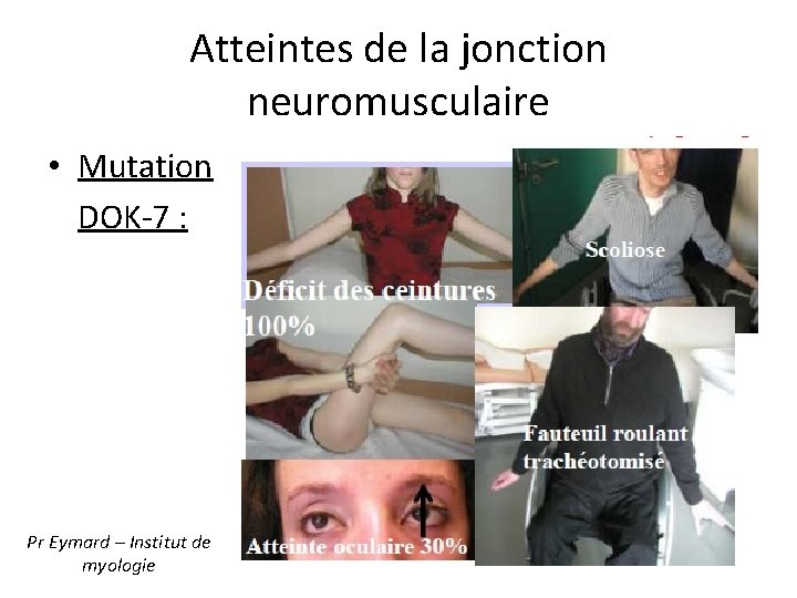 Atteintes de la jonction neuromusculaire • Mutation DOK-7 : Pr Eymard – Institut de