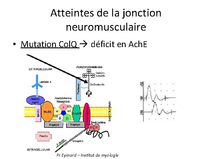 Atteintes de la jonction neuromusculaire • Mutation Col. Q déficit en Ach. E Pr