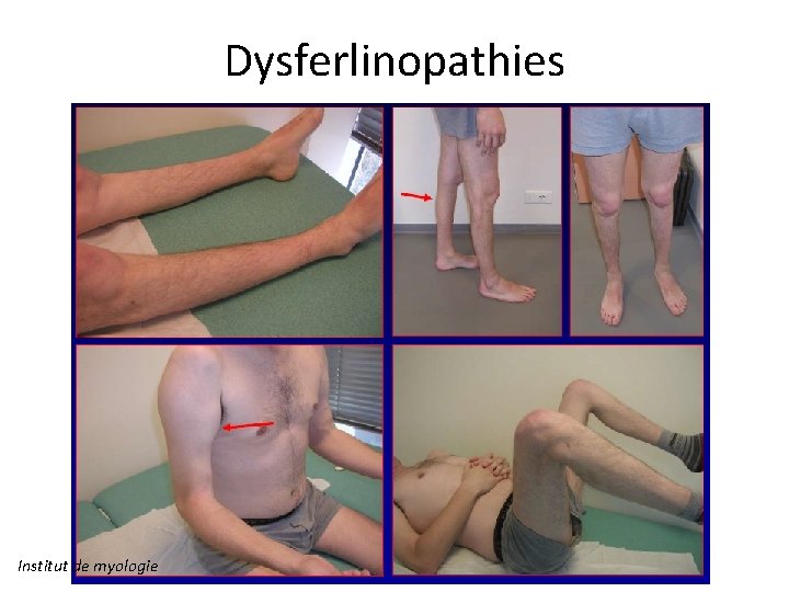 Dysferlinopathies Institut de myologie 