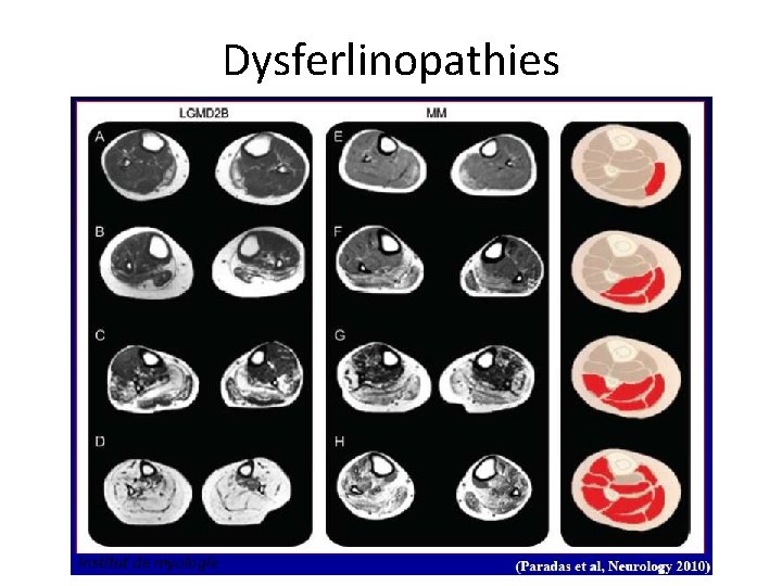 Dysferlinopathies Institut de myologie 