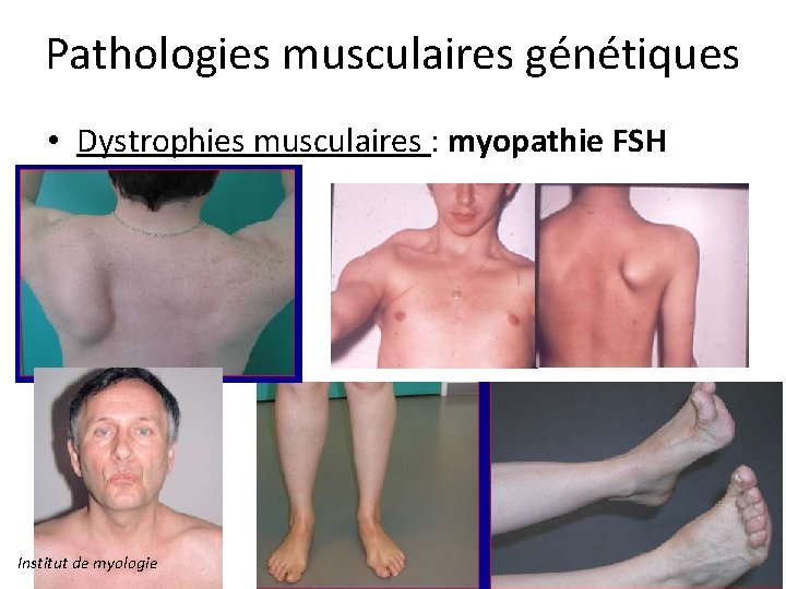Pathologies musculaires génétiques • Dystrophies musculaires : myopathie FSH Institut de myologie 