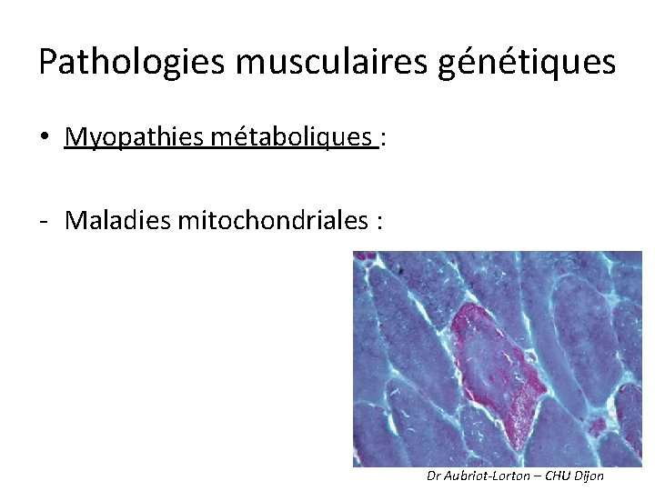 Pathologies musculaires génétiques • Myopathies métaboliques : - Maladies mitochondriales : Dr Aubriot-Lorton –