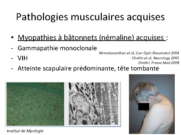 Pathologies musculaires acquises • Myopathies à bâtonnets (némaline) acquises : - Gammapathie monoclonale Nirmalananthan