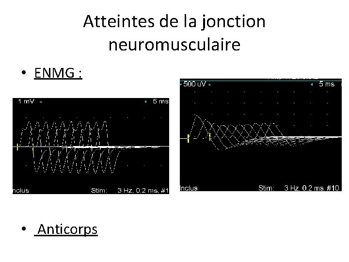 Atteintes de la jonction neuromusculaire • ENMG : • Anticorps 