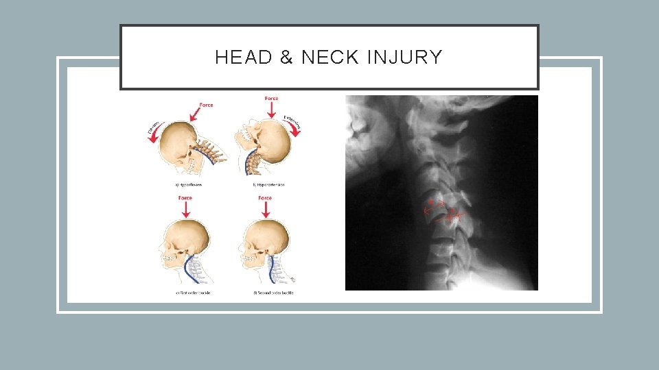 HEAD & NECK INJURY 