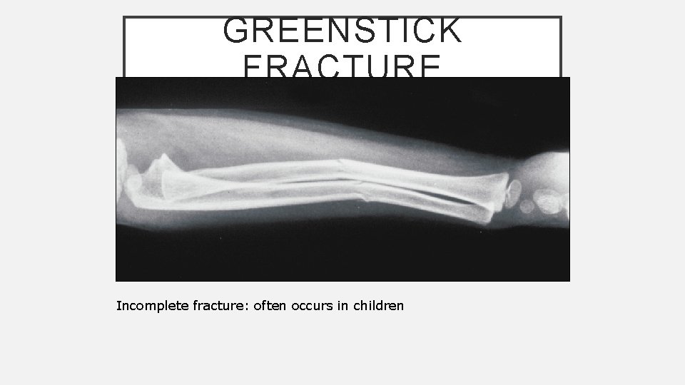 GREENSTICK FRACTURE Incomplete fracture: often occurs in children 