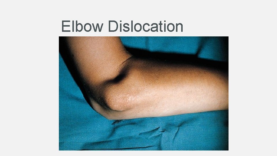 Elbow Dislocation 