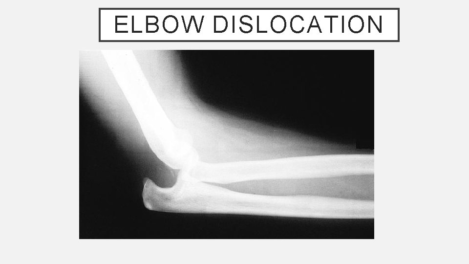 ELBOW DISLOCATION 