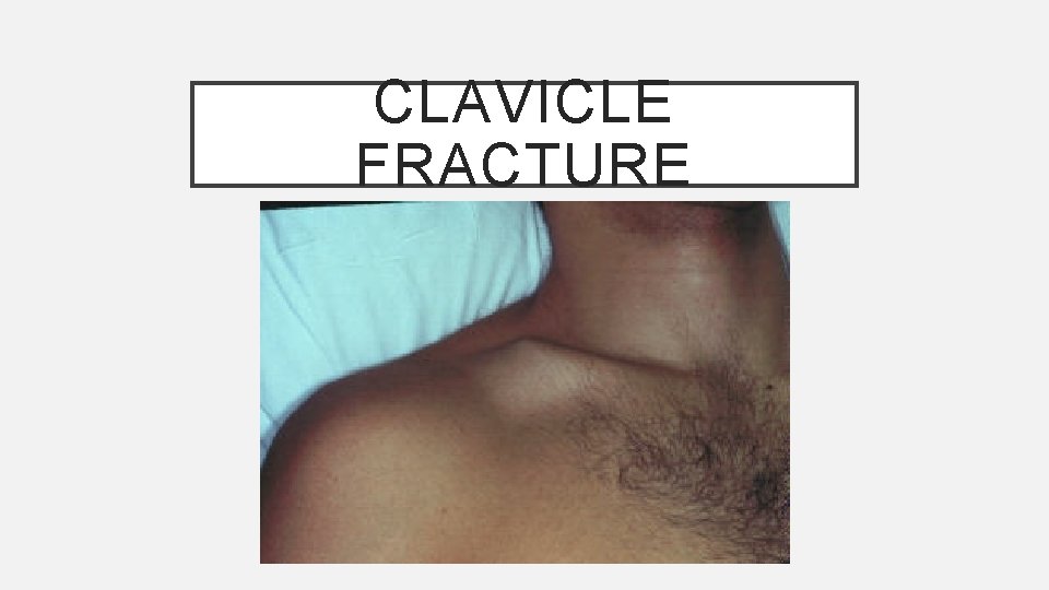 CLAVICLE FRACTURE 
