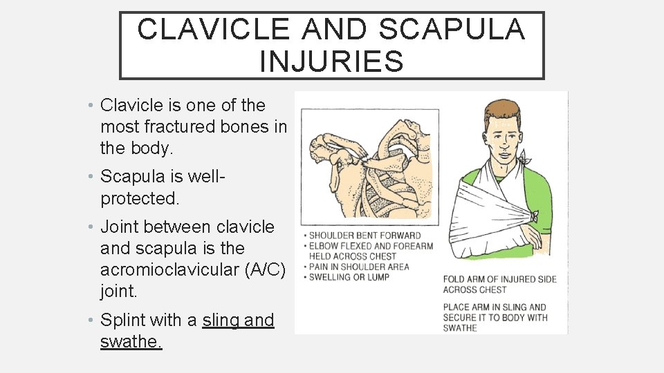 CLAVICLE AND SCAPULA INJURIES • Clavicle is one of the most fractured bones in