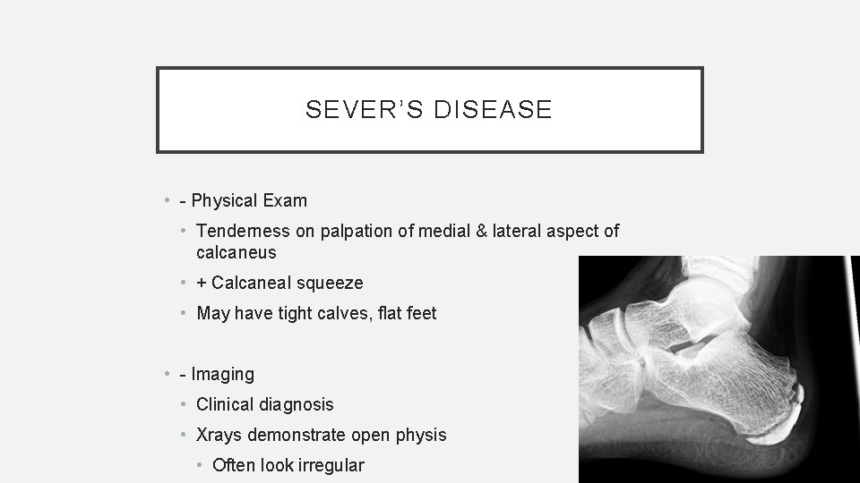 SEVER’S DISEASE • - Physical Exam • Tenderness on palpation of medial & lateral