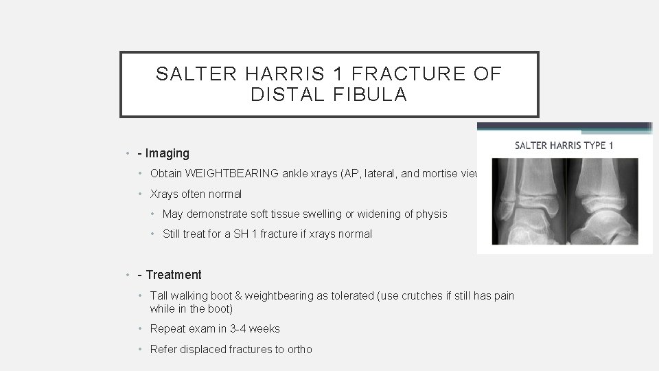 SALTER HARRIS 1 FRACTURE OF DISTAL FIBULA • - Imaging • Obtain WEIGHTBEARING ankle