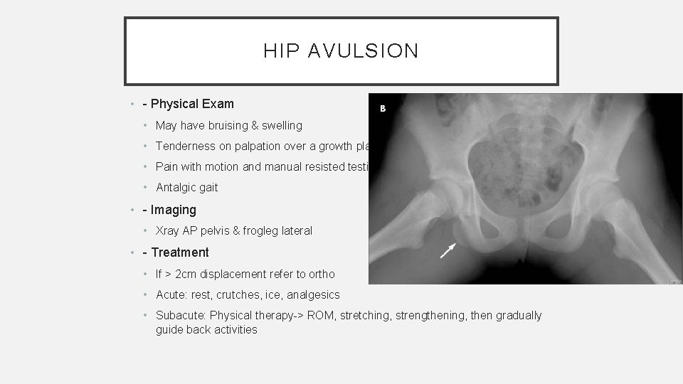 HIP AVULSION • - Physical Exam • May have bruising & swelling • Tenderness