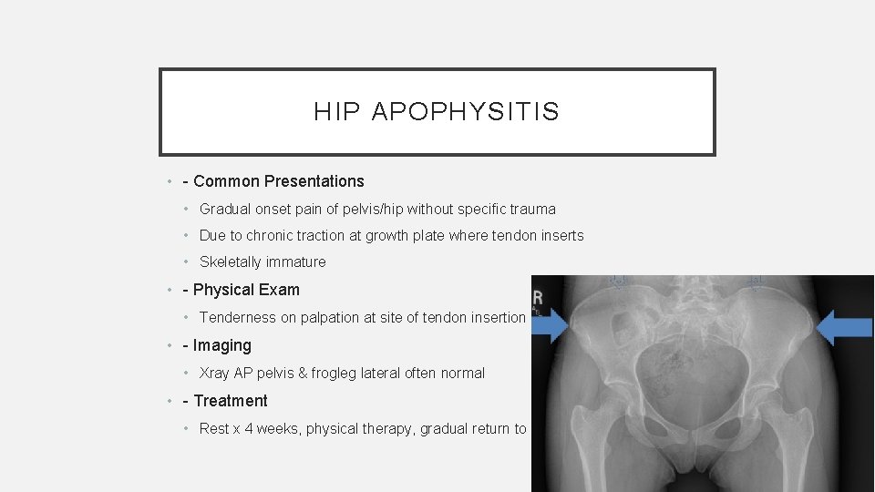 HIP APOPHYSITIS • - Common Presentations • Gradual onset pain of pelvis/hip without specific