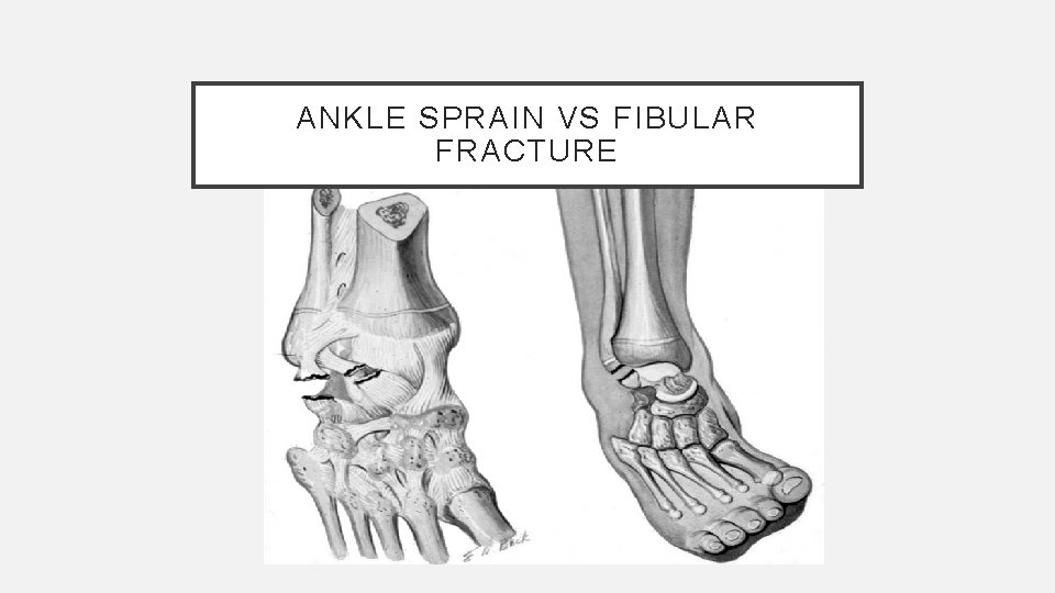 ANKLE SPRAIN VS FIBULAR FRACTURE 